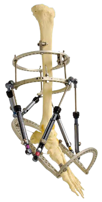 TrueLok™ Hex System