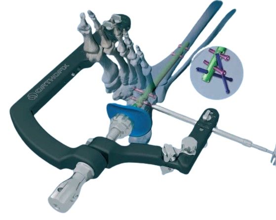 Sprunggelenk-Arthrodese-Nagelsystem